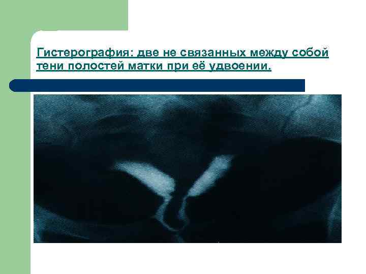 Гистерография: две не связанных между собой тени полостей матки при её удвоении. 