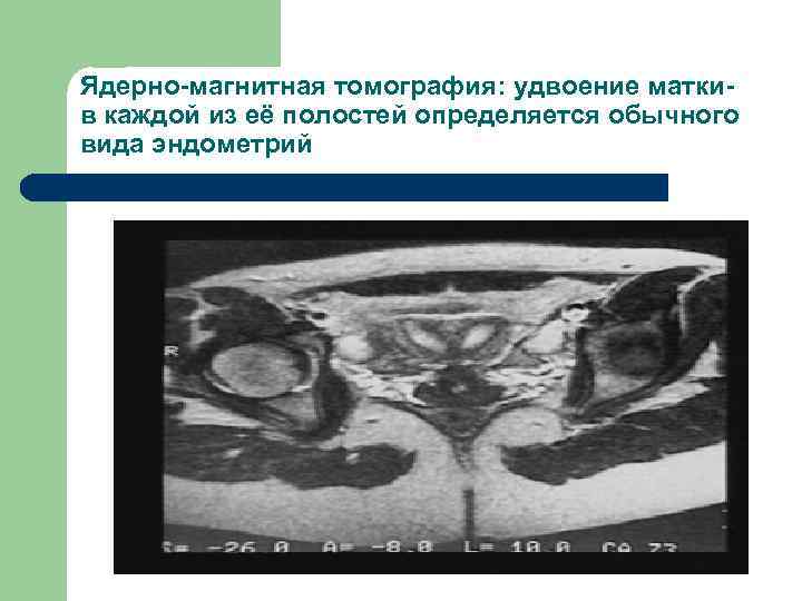 Ядерно-магнитная томография: удвоение матки- в каждой из её полостей определяется обычного вида эндометрий 