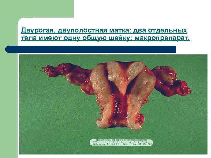 Двурогая, двуполостная матка: два отдельных тела имеют одну общую шейку; макропрепарат. 