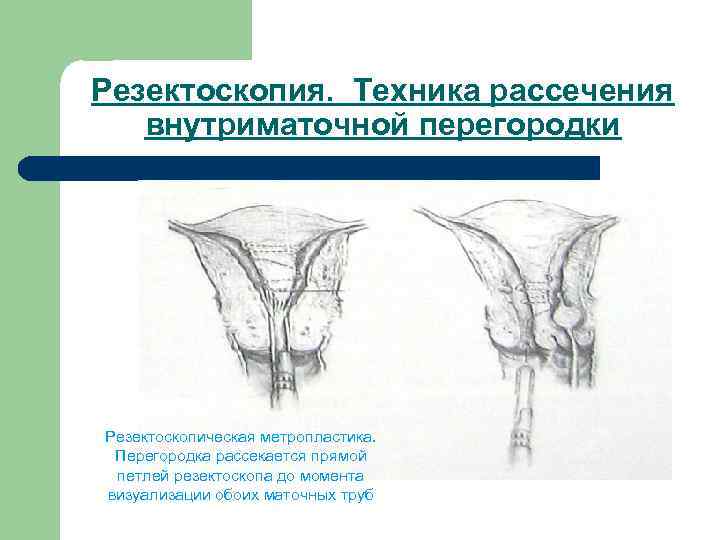 Резектоскопия. Техника рассечения внутриматочной перегородки Резектоскопическая метропластика. Перегородка рассекается прямой петлей резектоскопа до момента