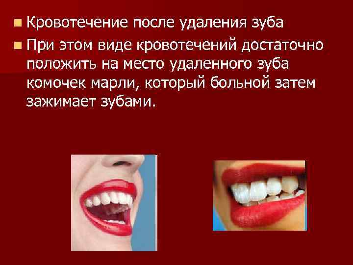 n Кровотечение после удаления зуба n При этом виде кровотечений достаточно положить на место