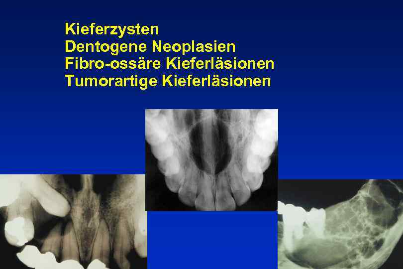 Kieferzysten Dentogene Neoplasien Fibro-ossäre Kieferläsionen Tumorartige Kieferläsionen 