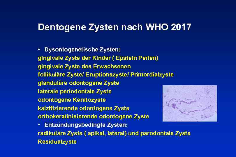 Dentogene Zysten nach WHO 2017 • Dysontogenetische Zysten: gingivale Zyste der Kinder ( Epstein
