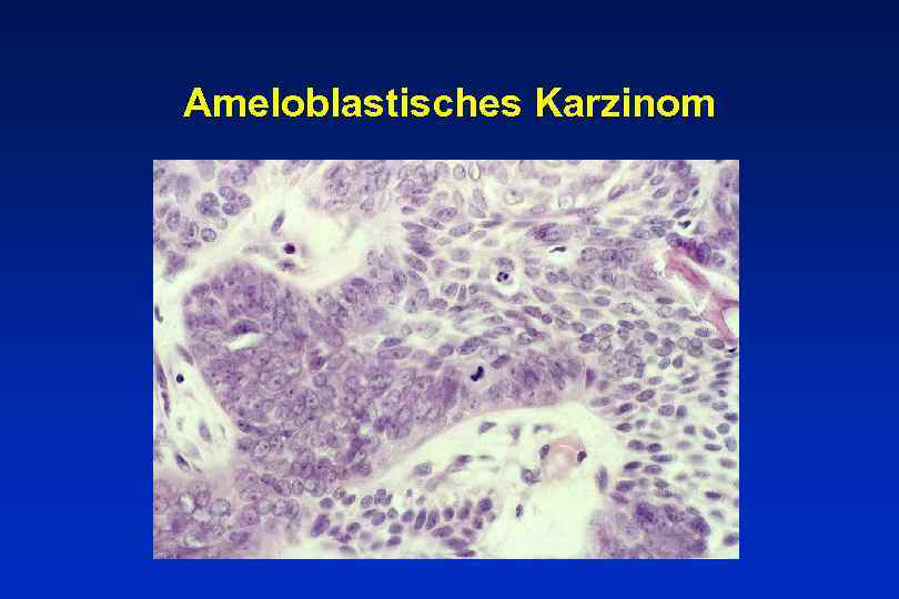 Ameloblastisches Karzinom 