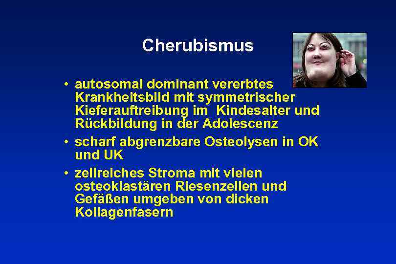 Cherubismus • autosomal dominant vererbtes Krankheitsbild mit symmetrischer Kieferauftreibung im Kindesalter und Rückbildung in