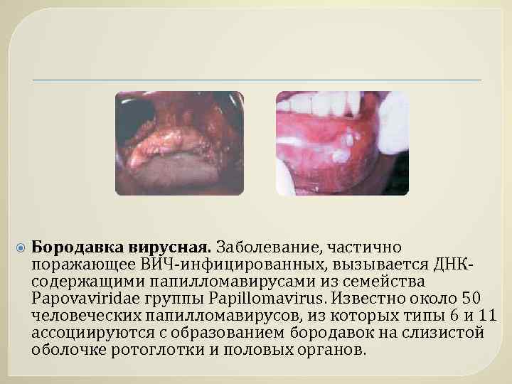  Бородавка вирусная. Заболевание, частично поражающее ВИЧ-инфицированных, вызывается ДНКсодержащими папилломавирусами из семейства Papovaviridae группы