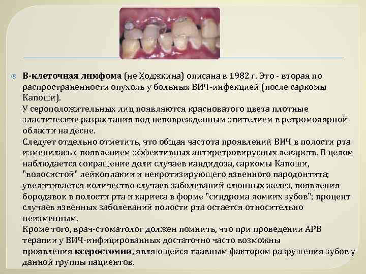  В-клеточная лимфома (не Ходжкина) описана в 1982 г. Это - вторая по распространенности