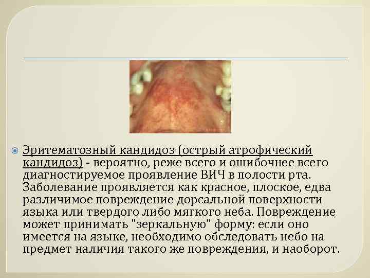  Эритематозный кандидоз (острый атрофический кандидоз) - вероятно, реже всего и ошибочнее всего диагностируемое