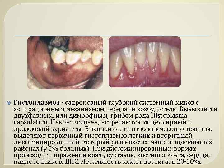  Гистоплазмоз - сапронозный глубокий системный микоз с аспирационным механизмом передачи возбудителя. Вызывается двухфазным,