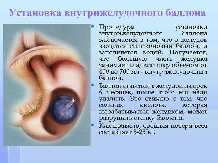 Установка внутрижелудочного баллона § Процедура установки внутрижелудочного баллона заключается в том, что в желудок