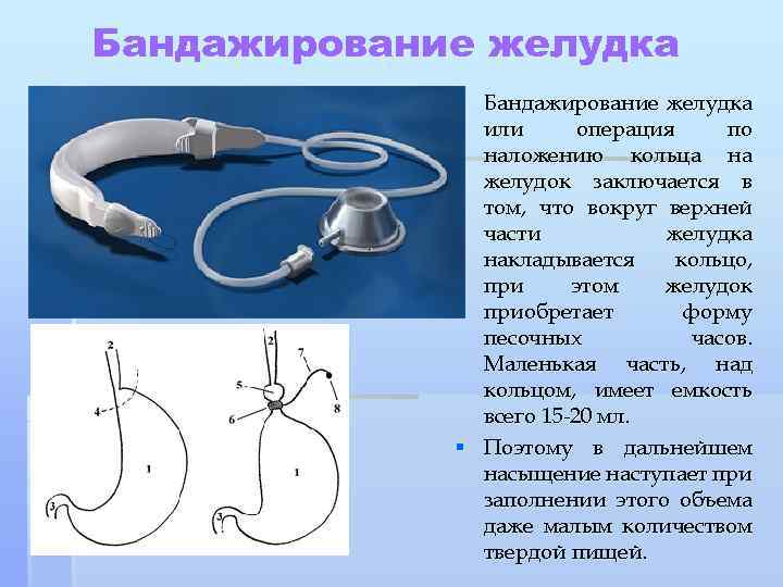 Бандажирование желудка § Бандажирование желудка или операция по наложению кольца на желудок заключается в