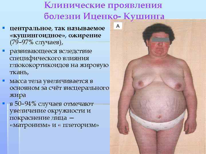 Клинические проявления болезни Иценко- Кушинга § центральное, так называемое «кушингоидное» , ожирение (79– 97%