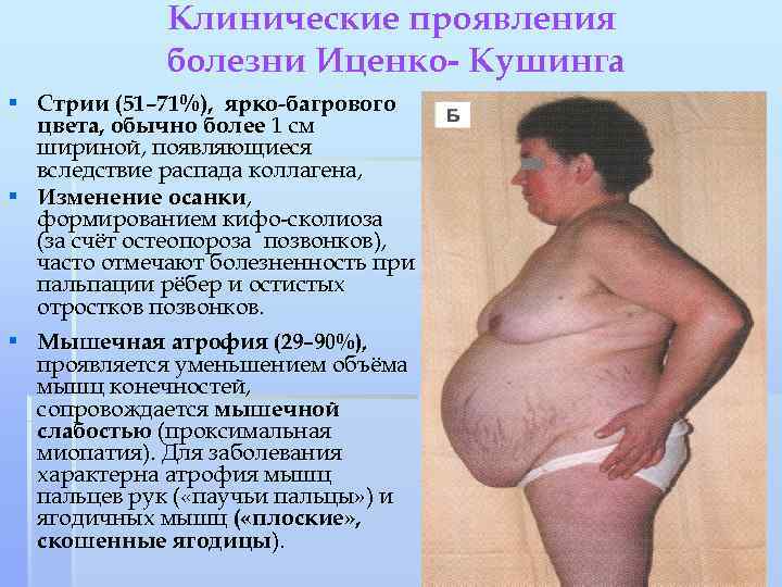 Клинические проявления болезни Иценко- Кушинга § Стрии (51– 71%), ярко-багрового цвета, обычно более 1