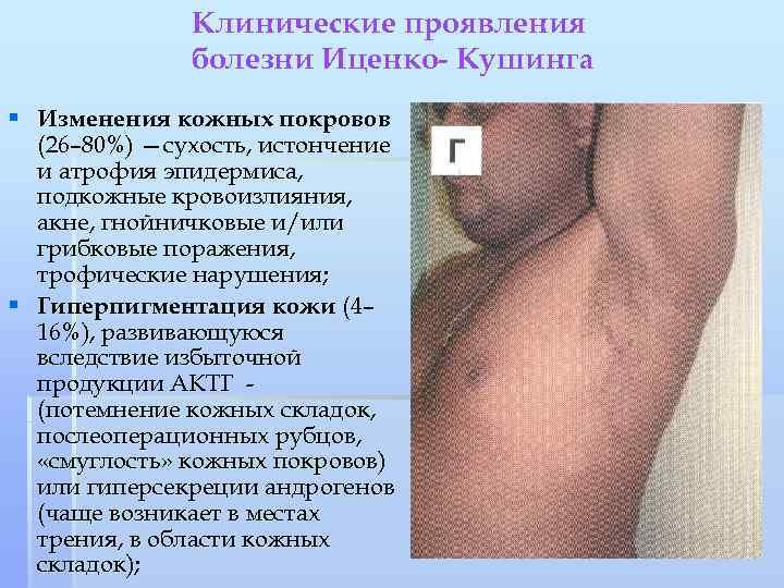 Клинические проявления болезни Иценко- Кушинга § Изменения кожных покровов (26– 80%) —сухость, истончение и
