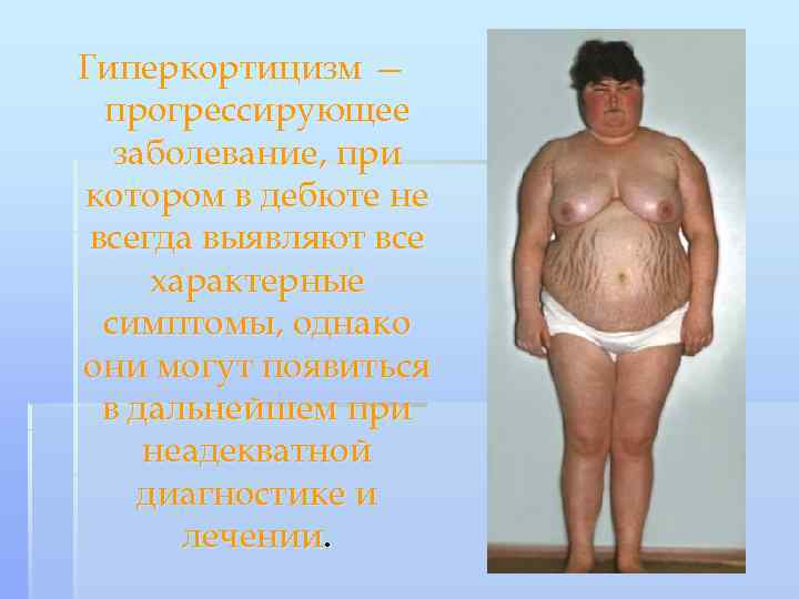 Гиперкортицизм — прогрессирующее заболевание, при котором в дебюте не всегда выявляют все характерные симптомы,