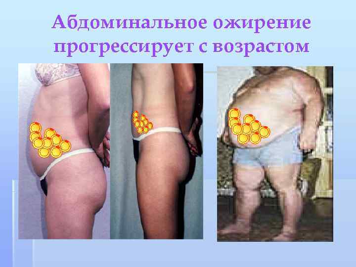 Абдоминальное ожирение прогрессирует с возрастом 