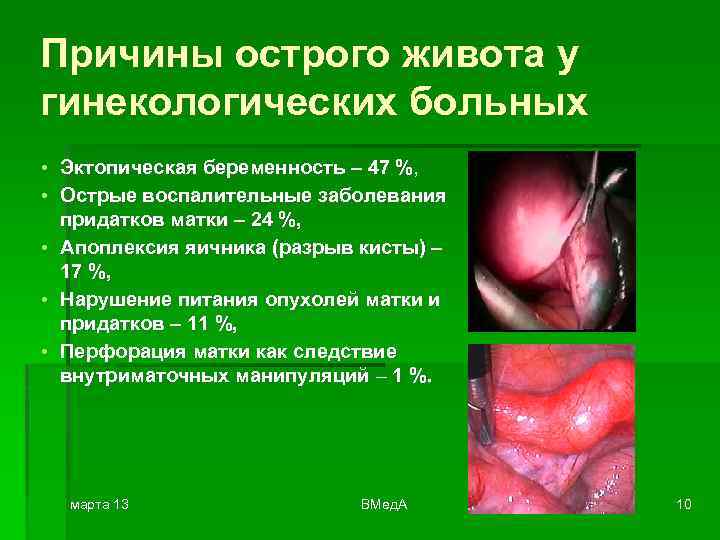 Причины острого живота у гинекологических больных • Эктопическая беременность – 47 %, • Острые