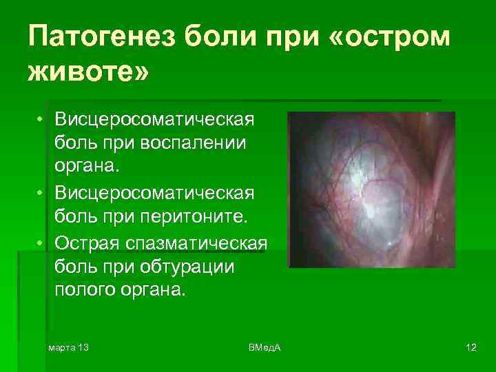 Патогенез боли при «остром животе» • Висцеросоматическая боль при воспалении органа. • Висцеросоматическая боль