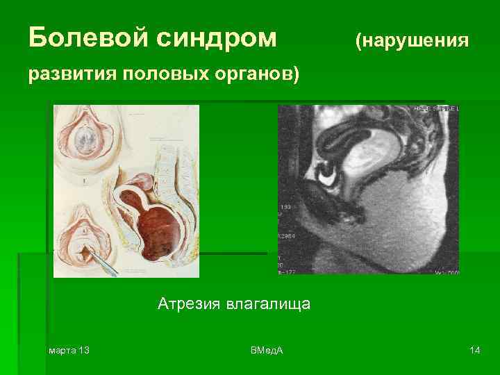 Болевой синдром (нарушения развития половых органов) Атрезия влагалища марта 13 ВМед. А 14 