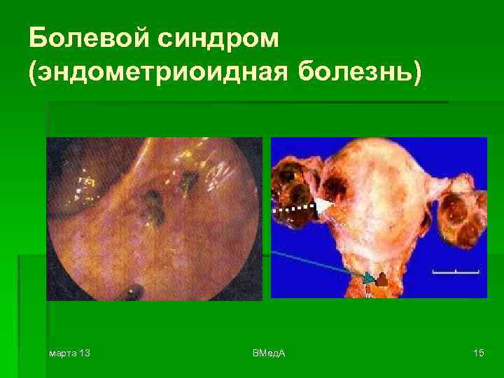 Болевой синдром (эндометриоидная болезнь) марта 13 ВМед. А 15 