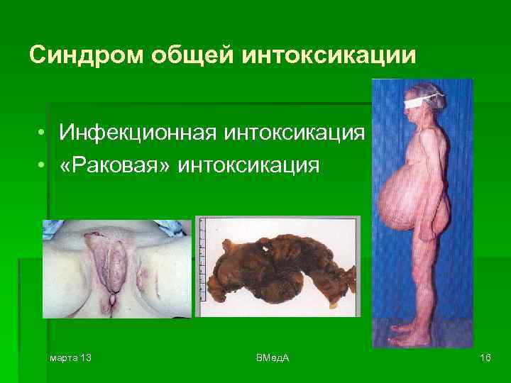 Синдром общей интоксикации • Инфекционная интоксикация • «Раковая» интоксикация марта 13 ВМед. А 16