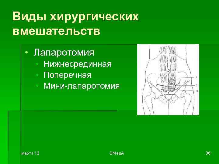 Виды хирургических вмешательств • Лапаротомия • • • марта 13 Нижнесрединная Поперечная Мини-лапаротомия ВМед.
