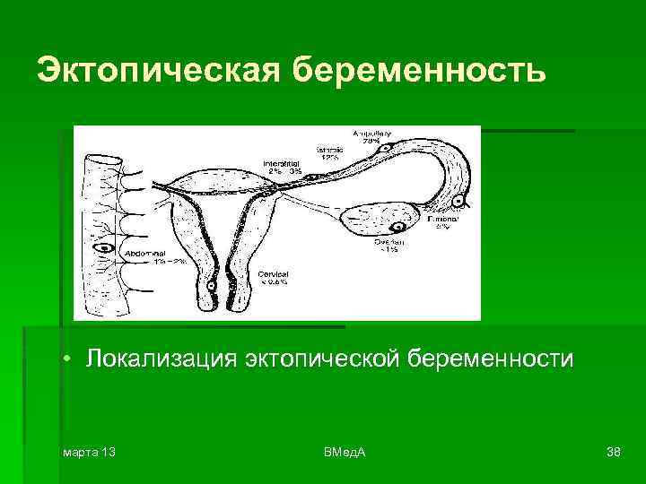 К клинической картине нарушенной эктопической беременности относятся