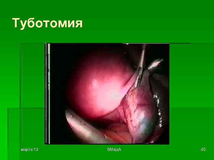 Туботомия марта 13 ВМед. А 40 