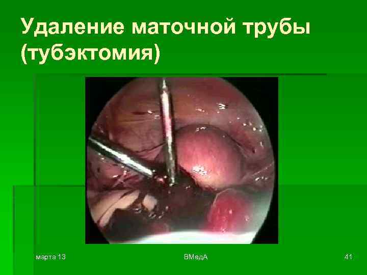 Удаление маточной трубы (тубэктомия) марта 13 ВМед. А 41 