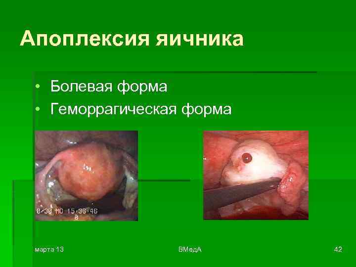 Апоплексия яичника • Болевая форма • Геморрагическая форма марта 13 ВМед. А 42 