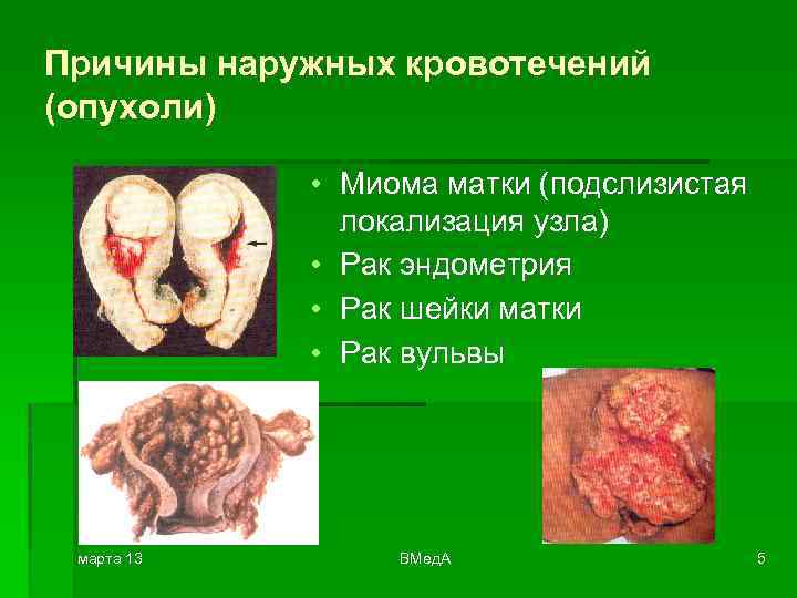 Причины наружных кровотечений (опухоли) • Миома матки (подслизистая локализация узла) • Рак эндометрия •