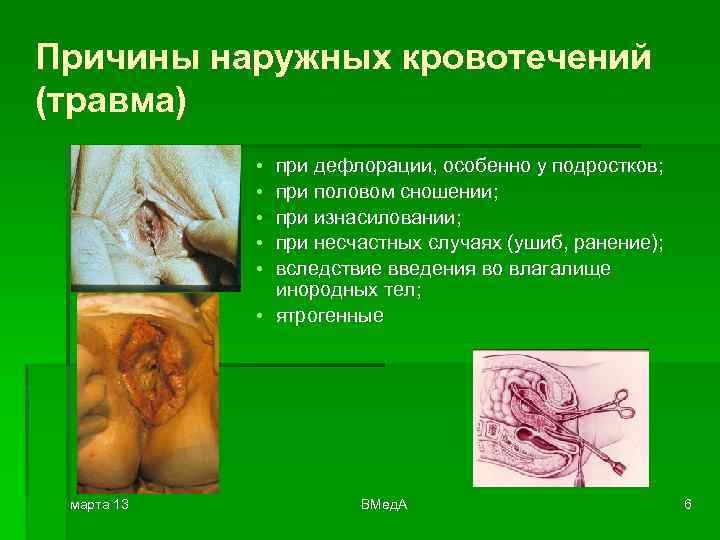 Причины наружных кровотечений (травма) • • • при дефлорации, особенно у подростков; при половом