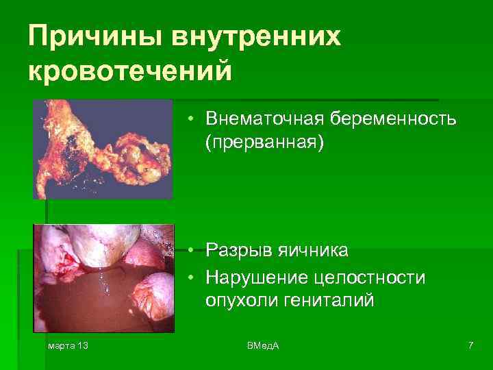 Причины внутренних кровотечений • Внематочная беременность (прерванная) • Разрыв яичника • Нарушение целостности опухоли