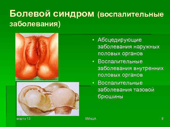 Болевой синдром (воспалительные заболевания) • Абсцедирующие заболевания наружных половых органов • Воспалительные заболевания внутренних