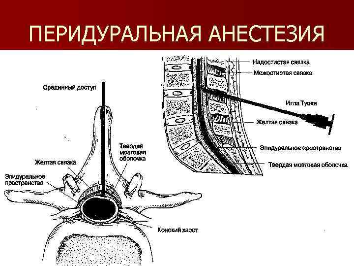 ПЕРИДУРАЛЬНАЯ АНЕСТЕЗИЯ 