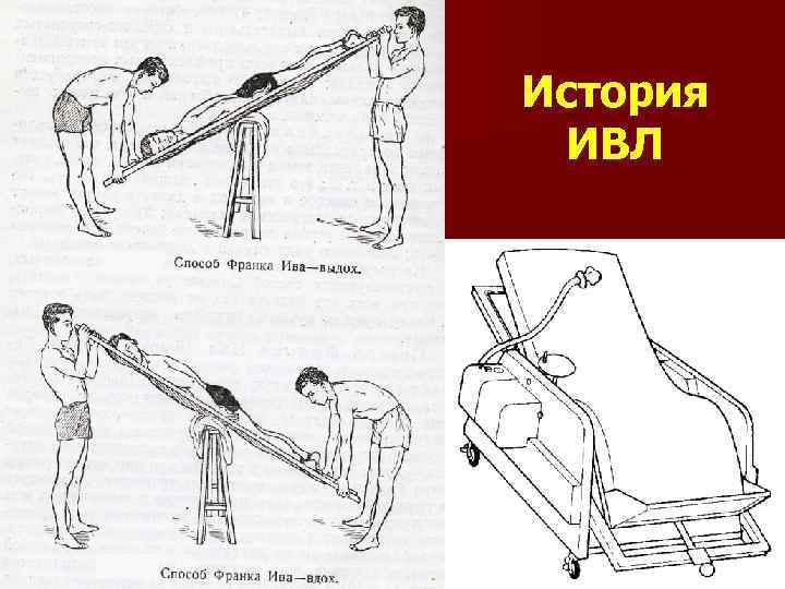 История ИВЛ 