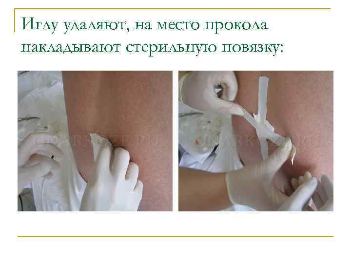 Иглу удаляют, на место прокола накладывают стерильную повязку: 