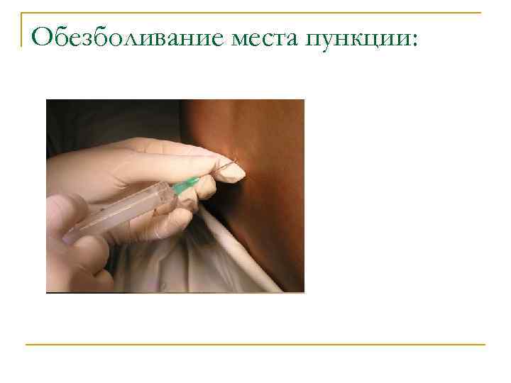 Обезболивание места пункции: 