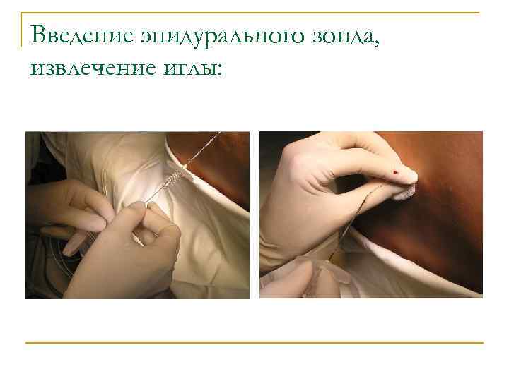 Введение эпидурального зонда, извлечение иглы: 