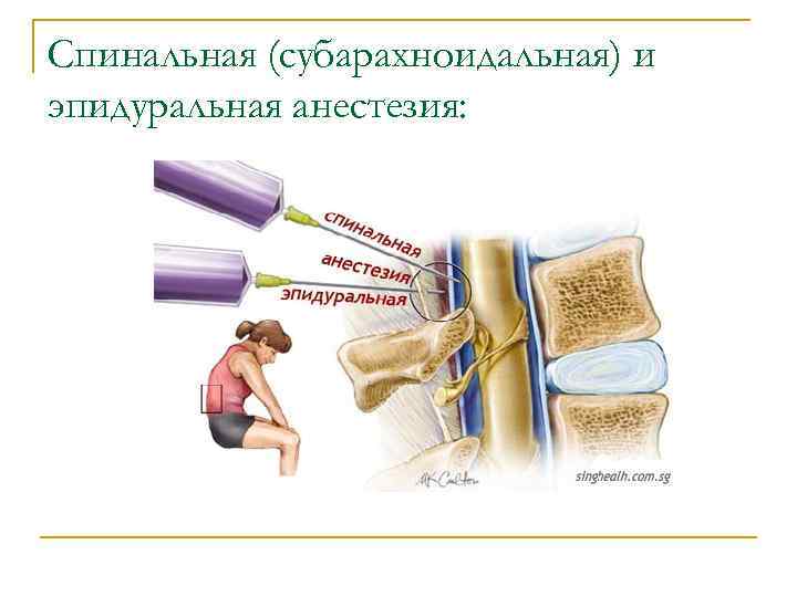 Спинальная (субарахноидальная) и эпидуральная анестезия: 
