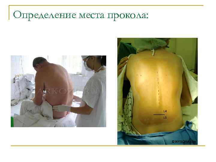 Определение места прокола: 