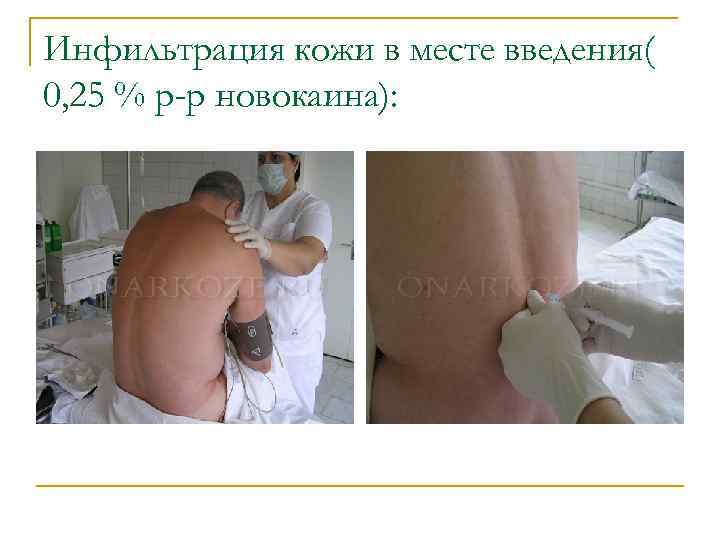 Инфильтрация кожи в месте введения( 0, 25 % р-р новокаина): 