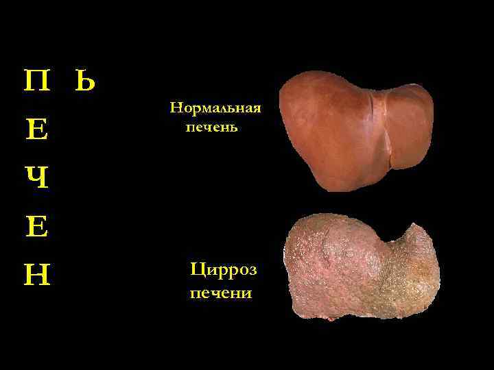 П Ь Е Ч Е Н Нормальная печень Цирроз печени 