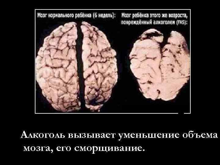Алкоголь вызывает уменьшение объема мозга, его сморщивание. 