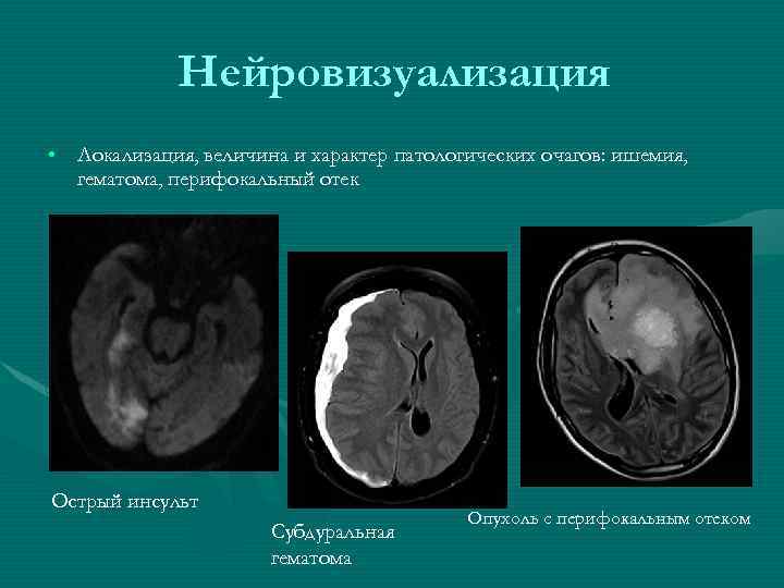 Нейровизуализация • Локализация, величина и характер патологических очагов: ишемия, гематома, перифокальный отек Острый инсульт