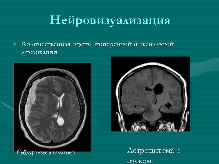 Нейровизуализация • Количественная оценка поперечной и аксиальной дислокации Субдуральная гематома Астроцитома с отеком 