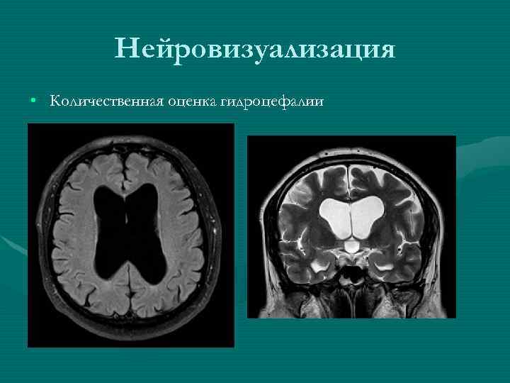 Нейровизуализация • Количественная оценка гидроцефалии 