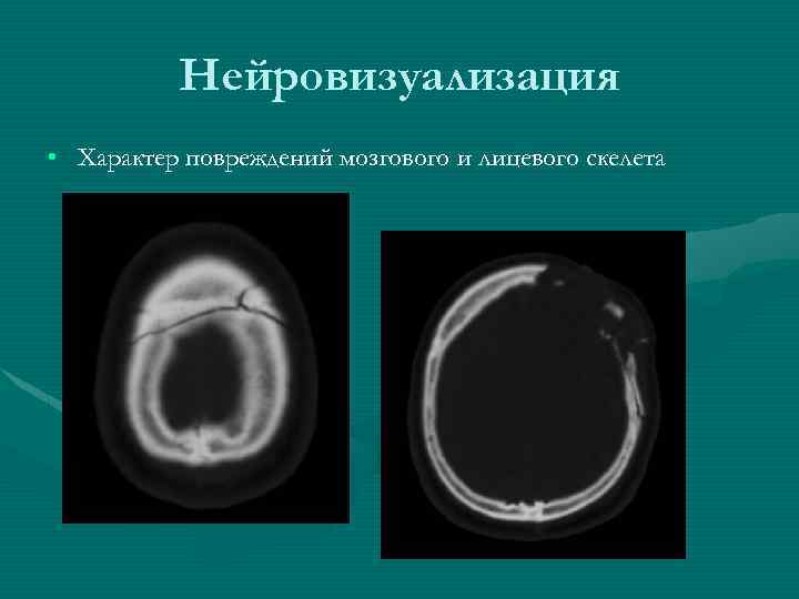 Нейровизуализация • Характер повреждений мозгового и лицевого скелета 