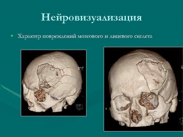 Нейровизуализация • Характер повреждений мозгового и лицевого скелета 