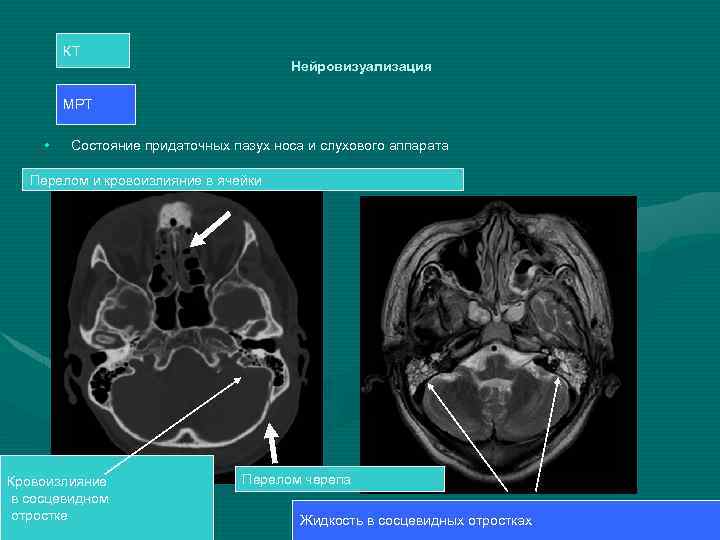 КТ Нейровизуализация МРТ • Состояние придаточных пазух носа и слухового аппарата Перелом и кровоизлияние